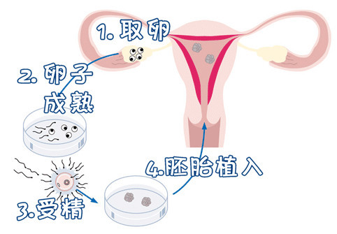 人工孕妈代怀咨询联系电话生殖中心